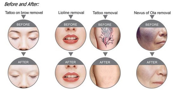 Máy xóa xăm cao cấp bằng laser YAG-KS 50S